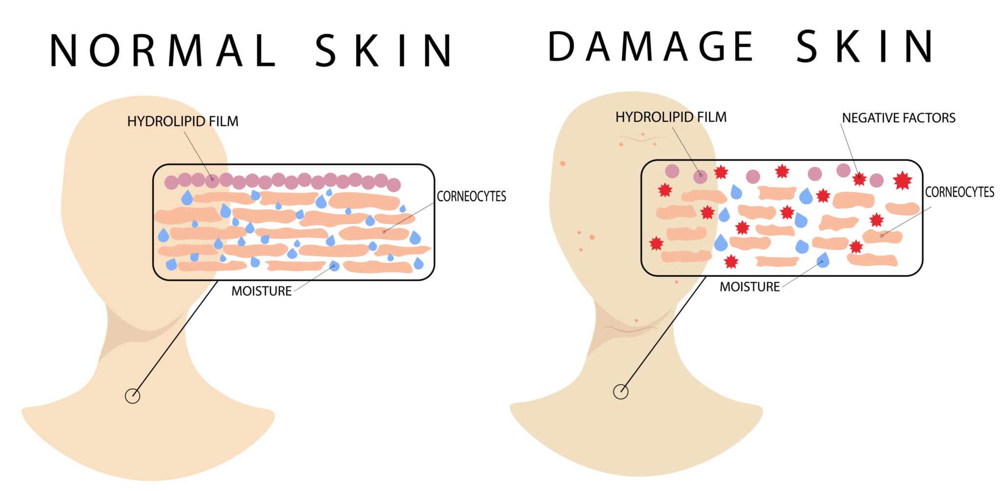 skin barrier